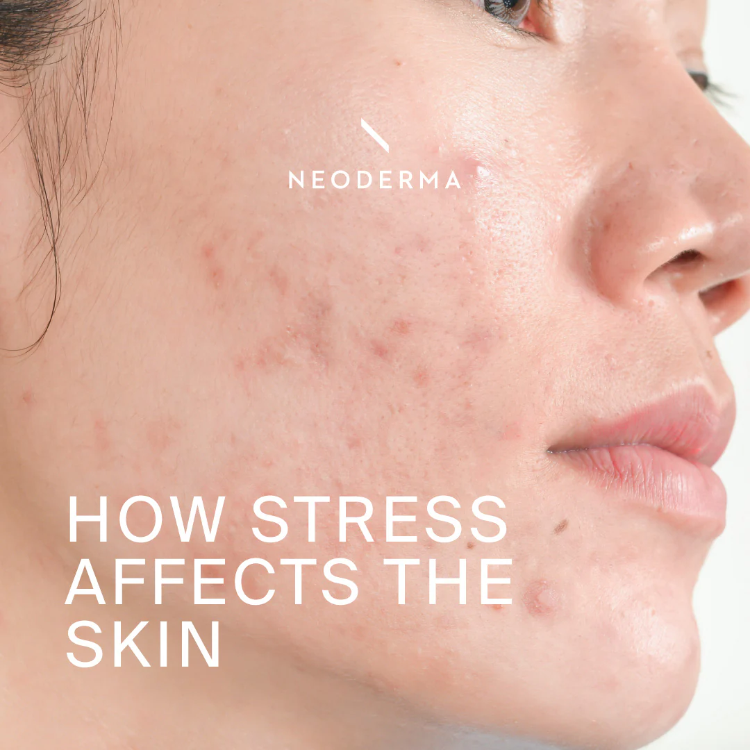 Stress and Sleep for Clear Skin