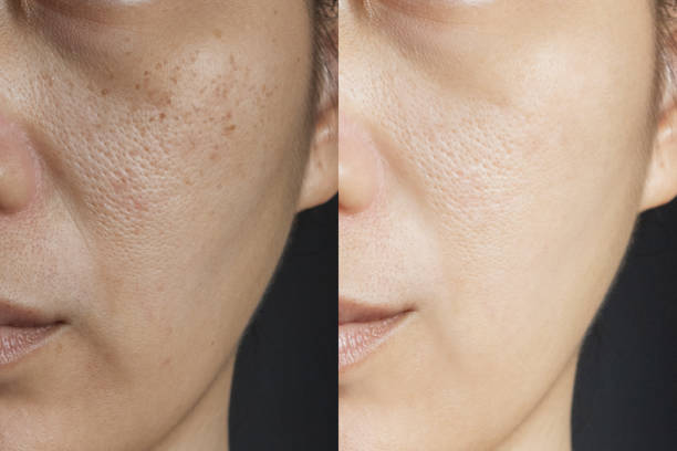 Before And After - Eyes Before And After - Eyes