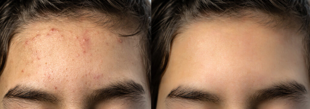 Before After (1)