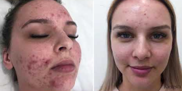 Before After (2)