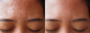 Before After (8)