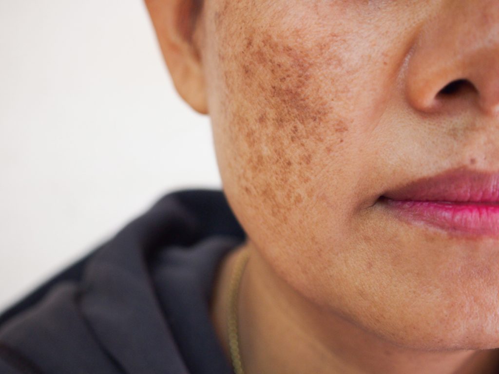 Pigmentation